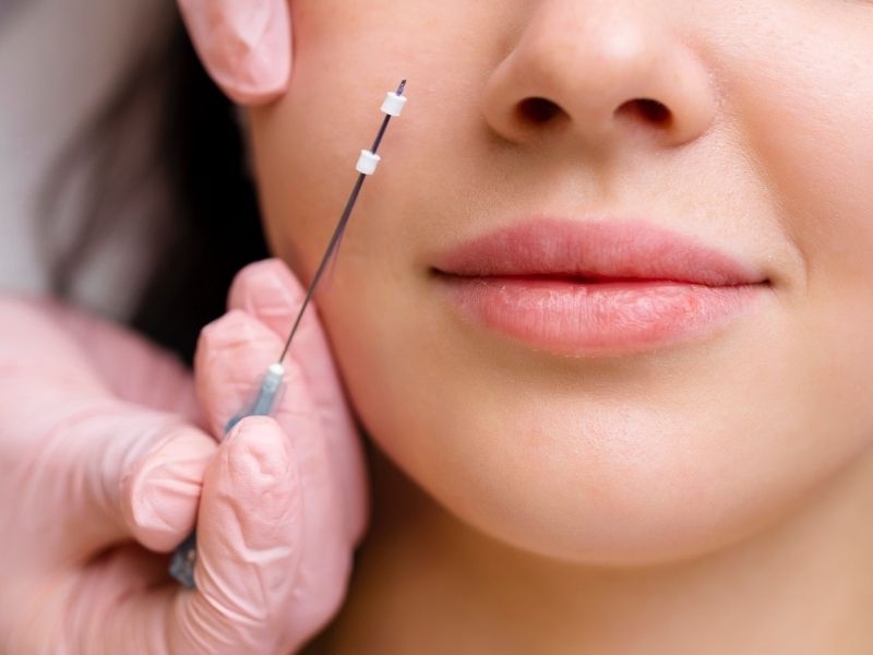 Fios De PDO: O Que São, Como Funcionam E Resultados No Rosto