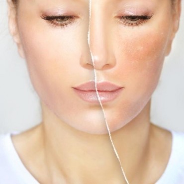 Tratamentos para Manchas em Mont'Serrat