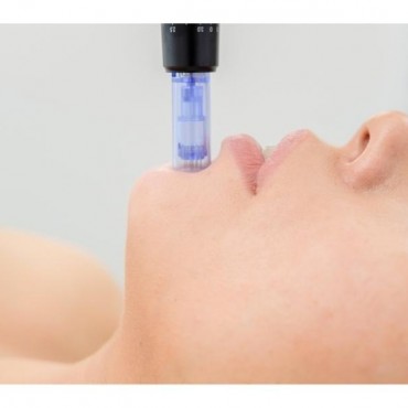 Microagulhamento em Mont'Serrat