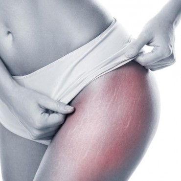 Tratamentos para Estria em Mont'Serrat