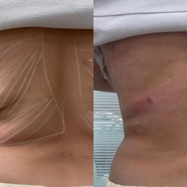 Endolifting em Mont'Serrat