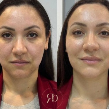 Derretimento de Face em Mont'Serrat