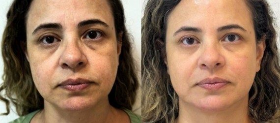 Derretimento de Face
